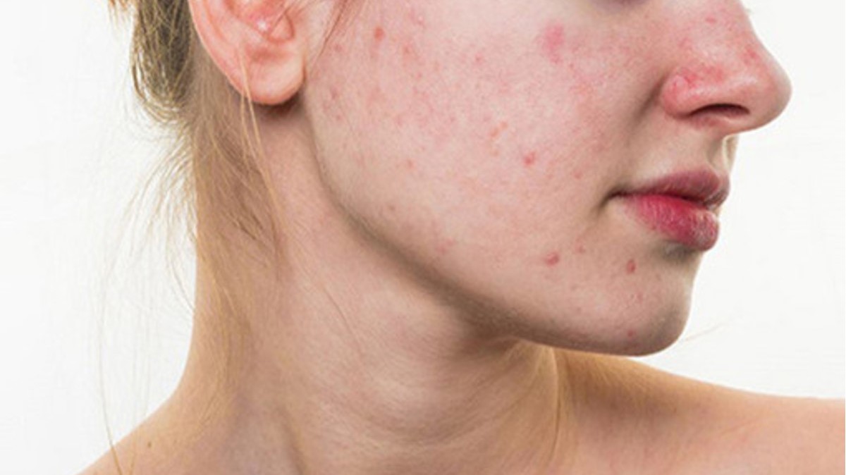 trị mụn sau sinh trị mụn sau sinh